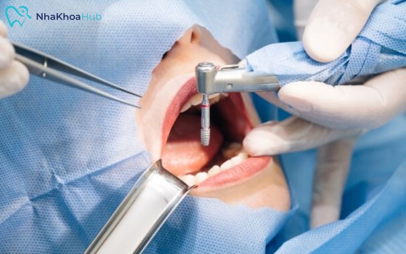 Quy trình thăm khám tại nha khoa Sakura nhanh chóng Quy trình thăm khám tại nha khoa Sakura nhanh chóng
