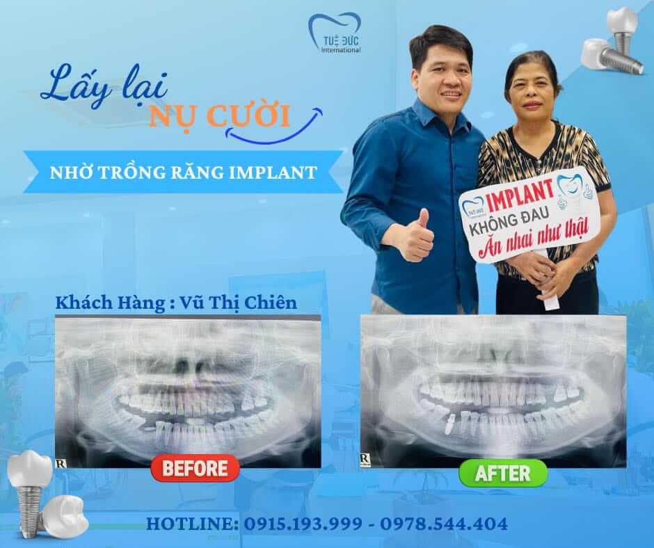 Câu chuyện thực tế - cô Chiên phục hình răng thành công