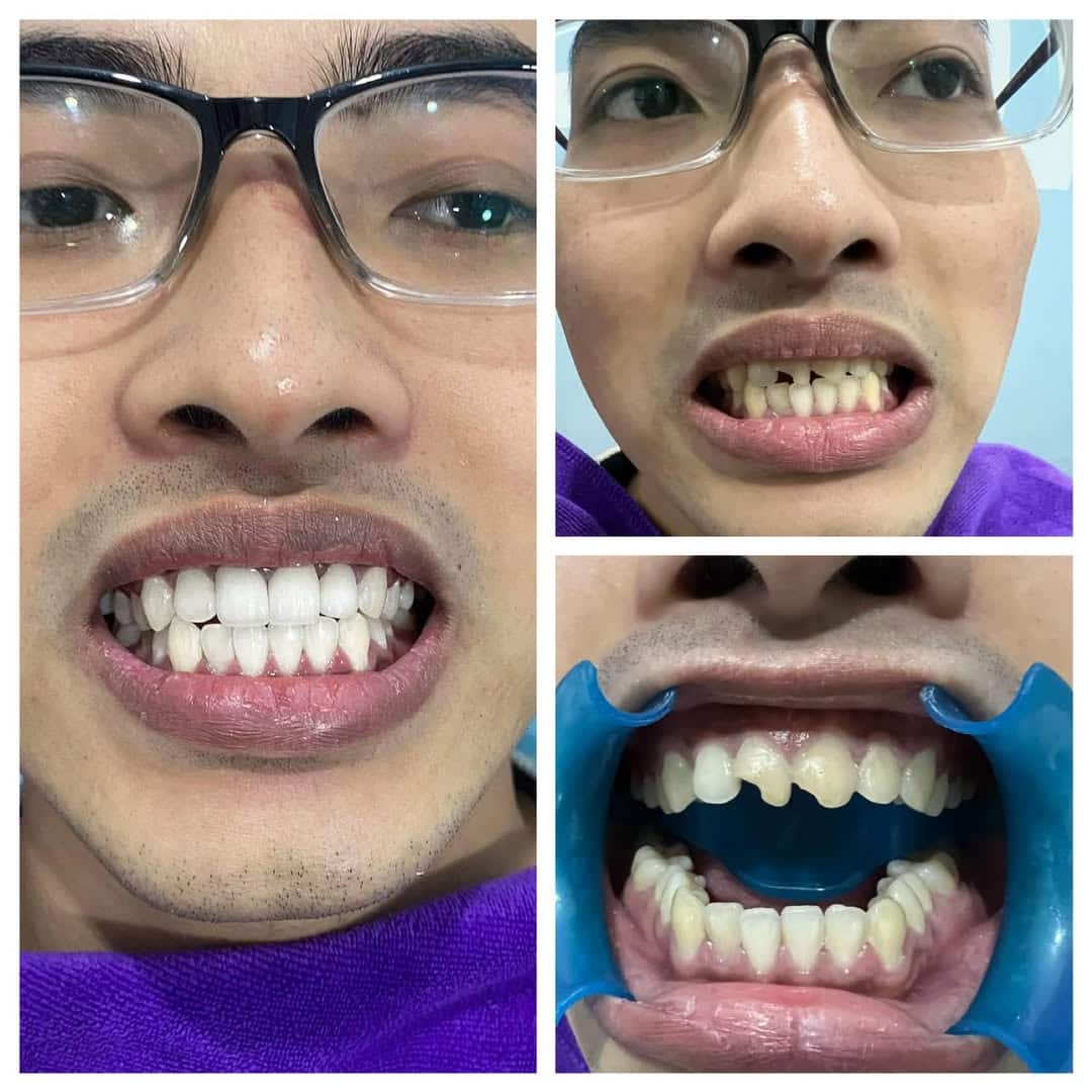 Anh Tùng (35 tuổi) chia sẻ về dịch vụ bọc răng sứ