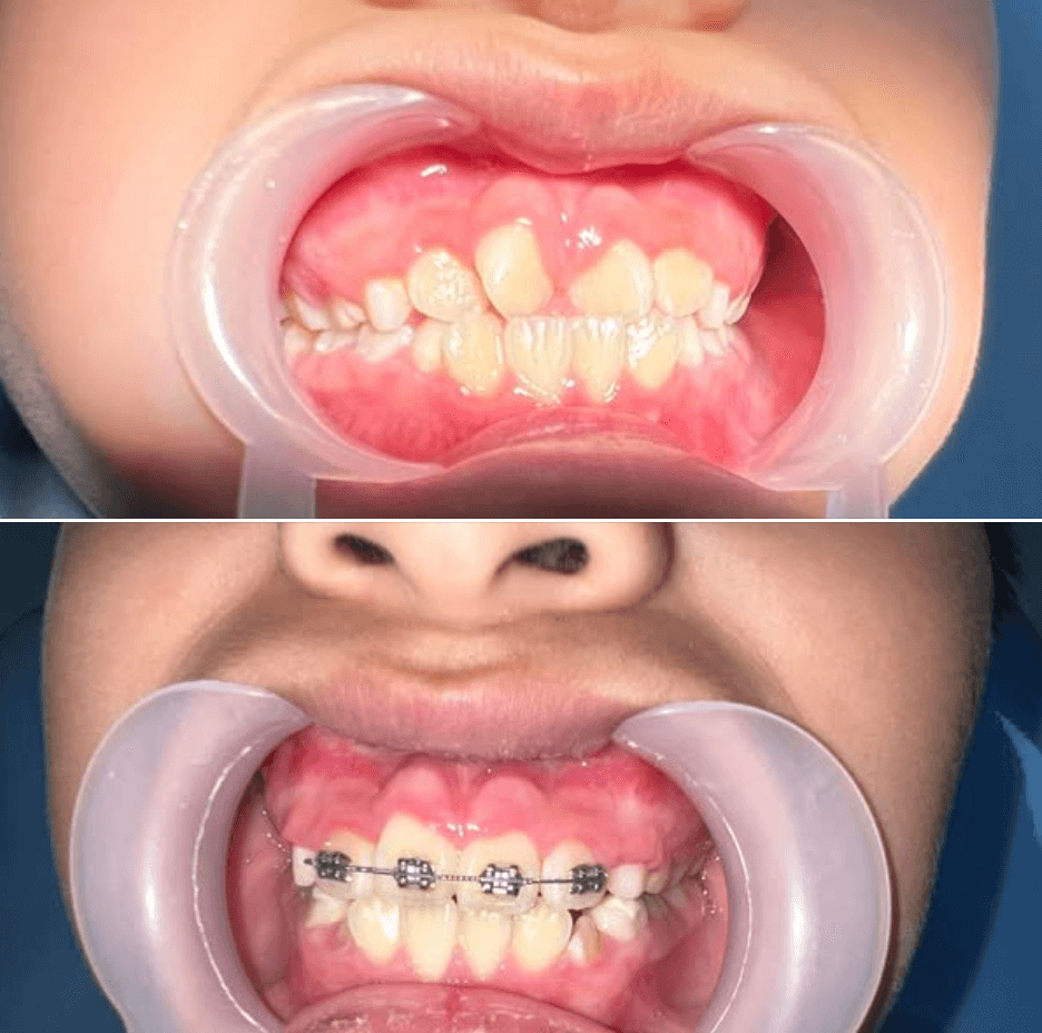 Chị Huyền Trần chia sẻ khi niềng răng cho con tại Phan Hằng