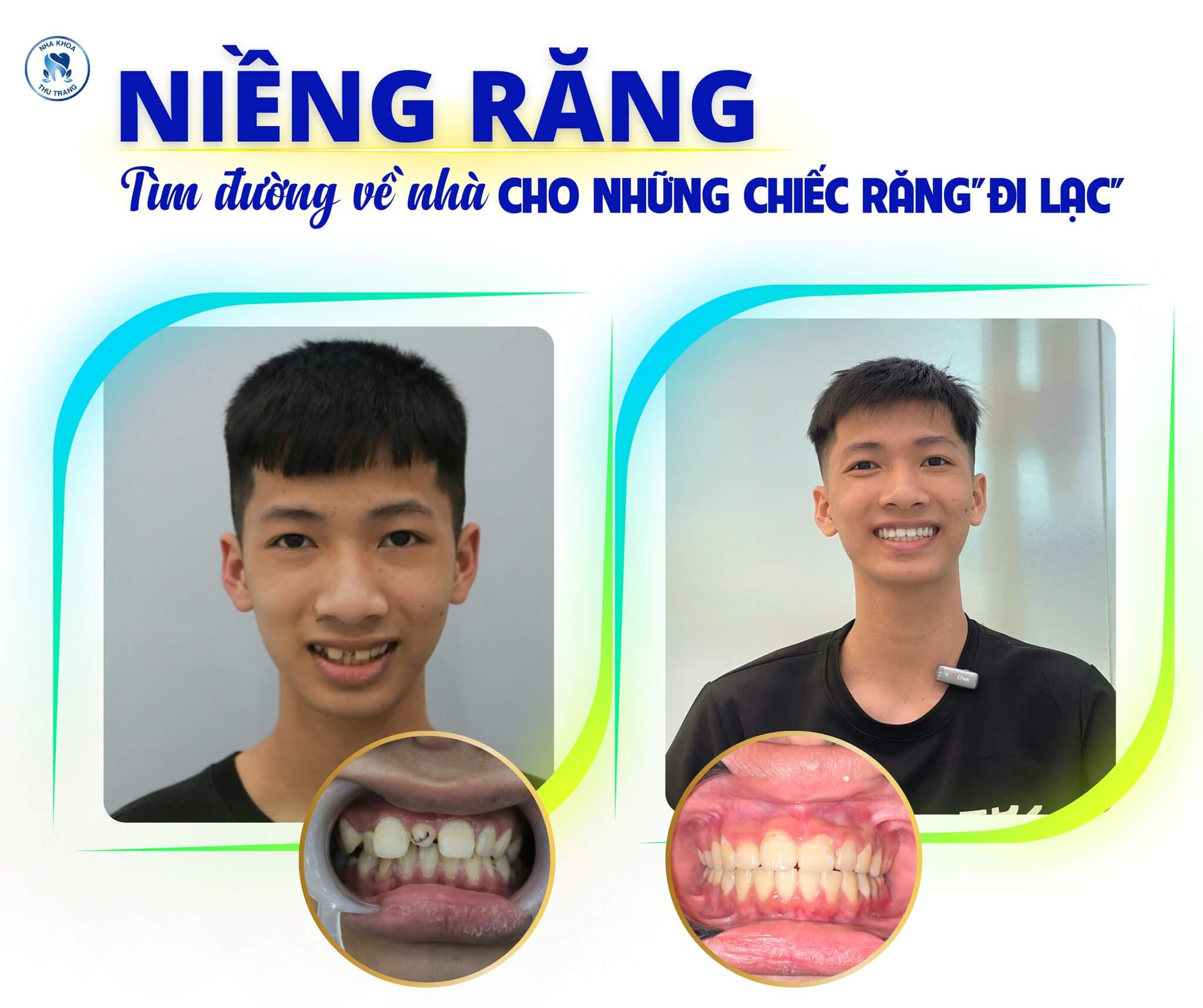 Nguyễn Văn Vinh (17 tuổi) chia sẻ hành trình niềng răng