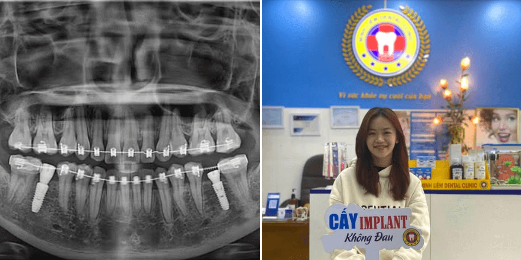 Bạn Nguyễn Thị Lan (20 tuổi) trồng 2 răng hàm