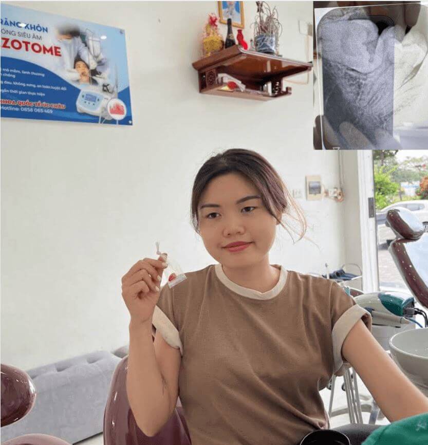 Khách hàng Thảo (Hà Đông) chia sẻ quá trình nhổ răng 8