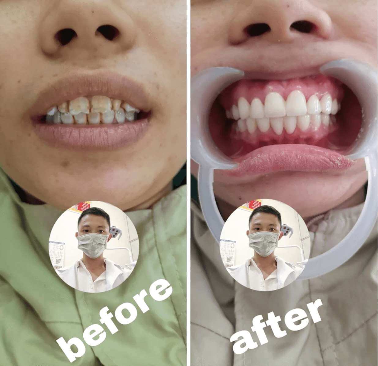 Khách hàng bọc 16 răng sứ tại Nụ Cười