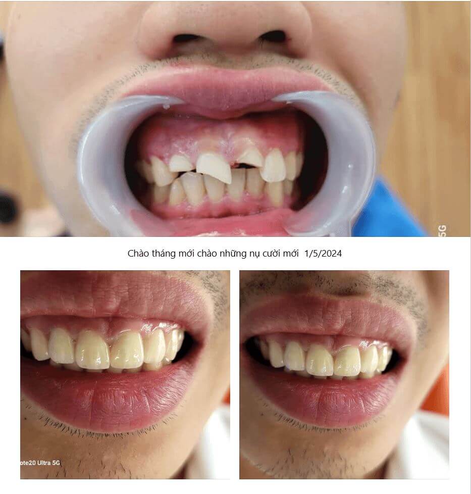 Review từ khách hàng trám răng thẩm mỹ