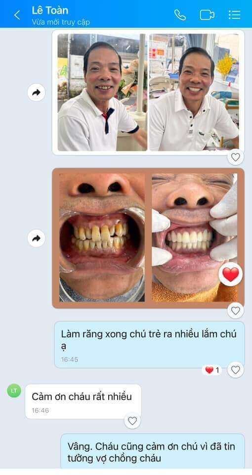 Chú Lê Toàn chia sẻ về trải nghiệm bọc sứ