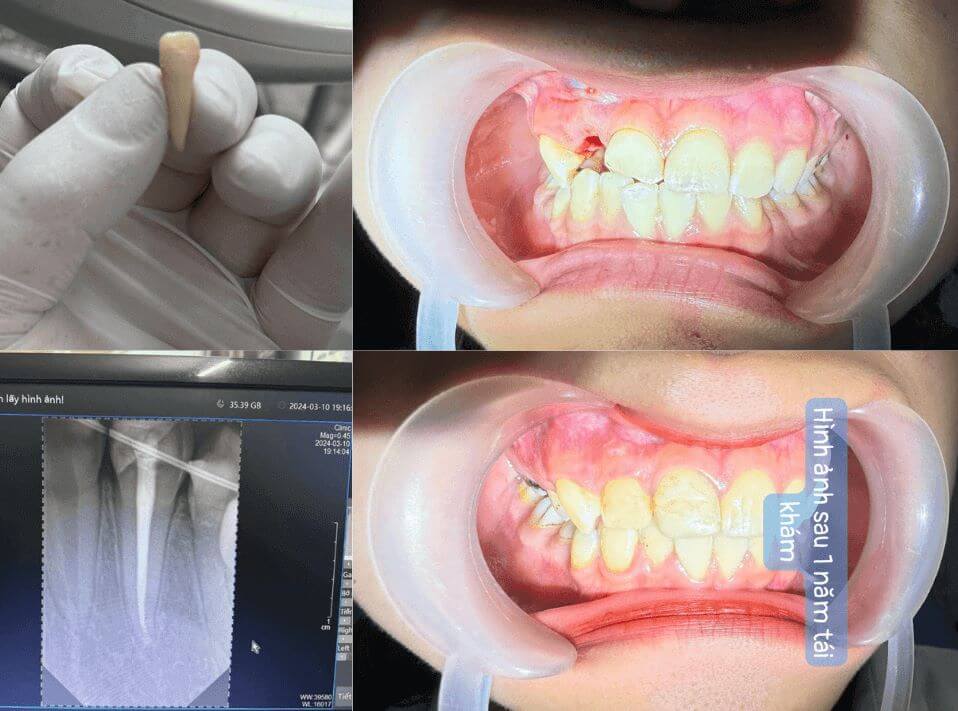 Chia sẻ từ khách hàng cắm lại răng lung lay