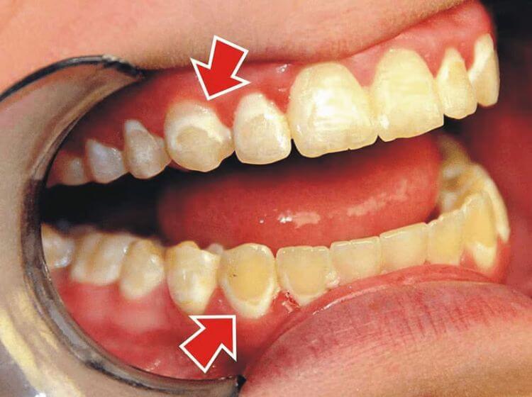 Viêm lợi răng lâu ngày khiến bệnh tiến triển nặng dễ bị viêm nha chu