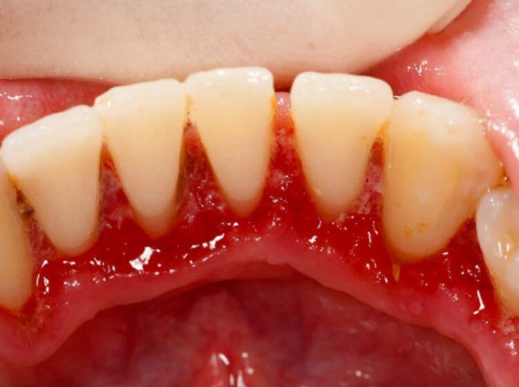 Lợi bị viêm sẽ chuyển sang màu đỏ sẫm hoặc tím